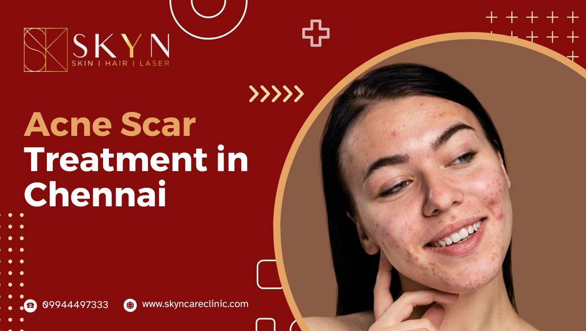 Acne Scar Treatment in Chennai