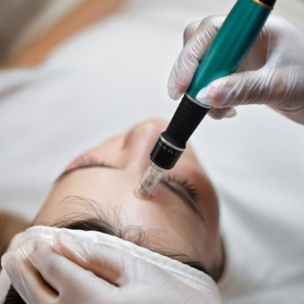 A patient undergoing microneedling treatment in Chennai for skin healing and tightening.