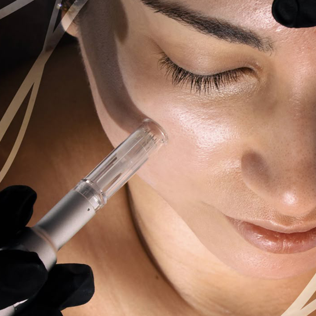 A dermatologist performing microneedling treatment in Chennai for acne scars